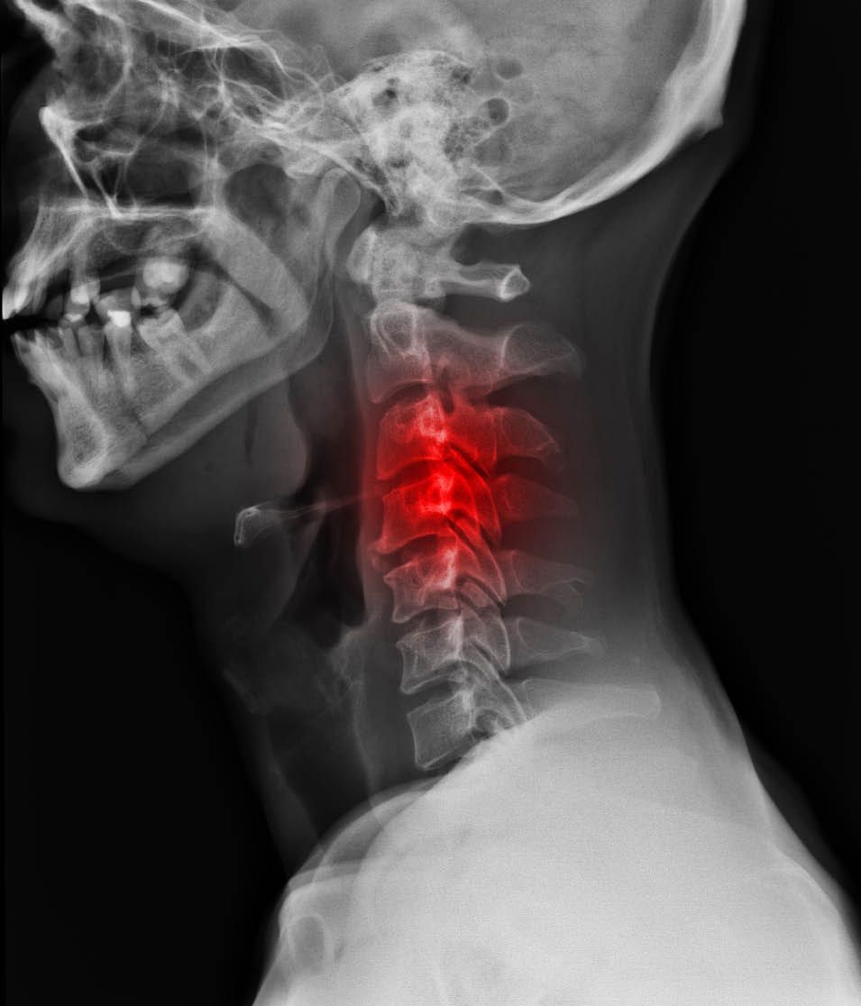 Neck Spinal Cord Pressure
