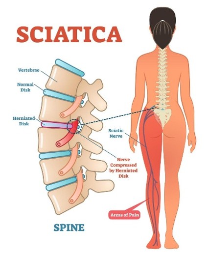 Sciatica leg pain treatment