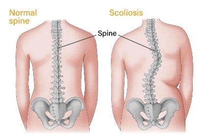 Spine deformity treatment