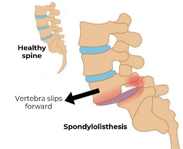 Degenerative disc disease treatment