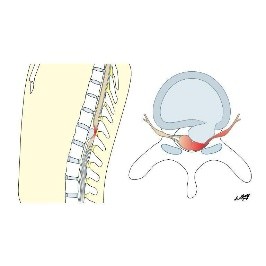 Lumbar slipped disc treatment