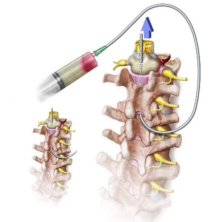 Spine infection treatment