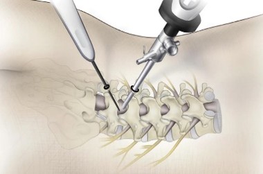 Endoscopic Spine Surgery