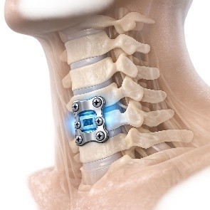 Cervical Spine Surgery