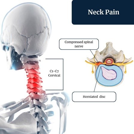 Cervical myelopathy treatment
