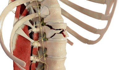 Thoracolumbar spine fracture treatment
