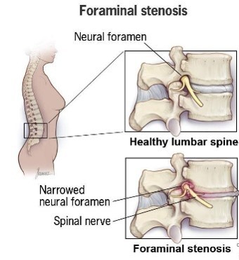Canal spine stenosis treatment