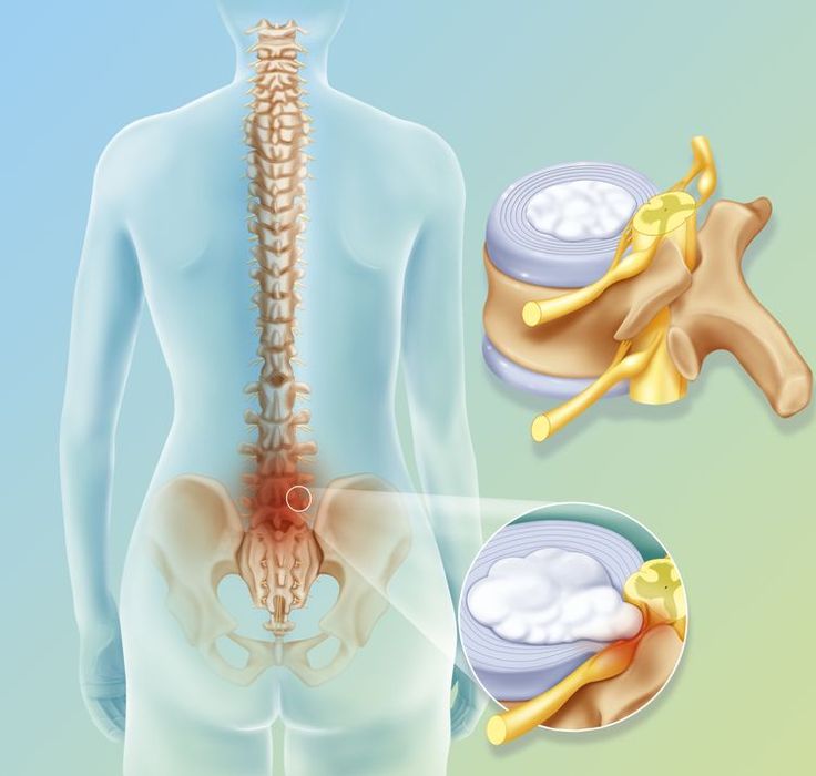 Slipped disc symptoms