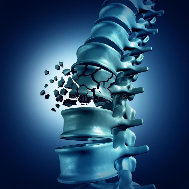 Spinal fracture