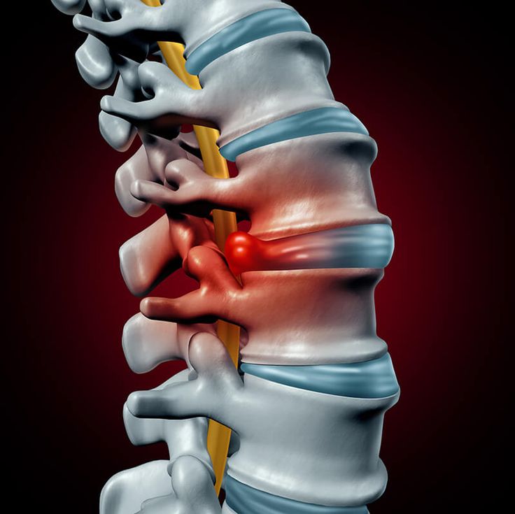 Herniated Disc and Slipped Disc