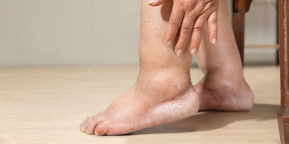 Leg heaviness