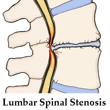 Lumbar canal stenosis treatment
