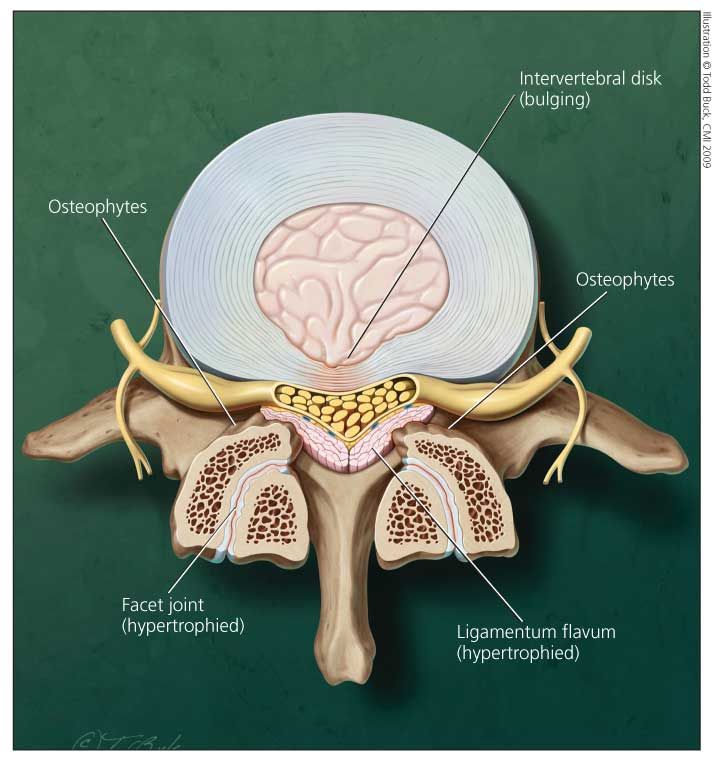 Lumbar stenosis treatment
