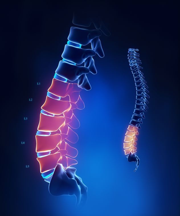 Lumbar stenosis symptoms