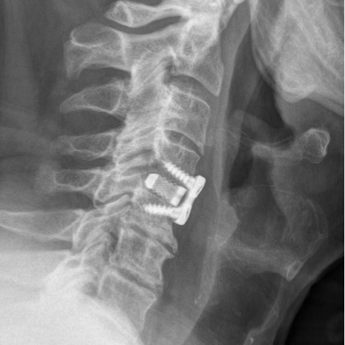 ACDF Surgery
