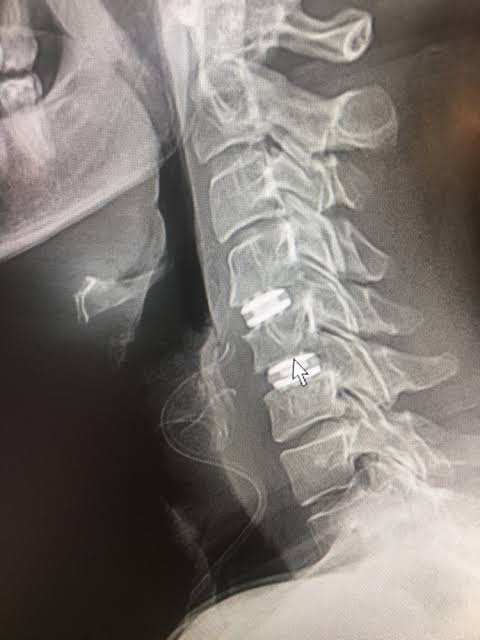 Posterior Decompression