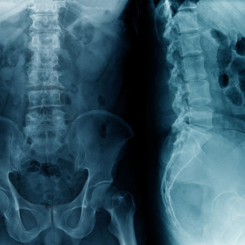 Keyhole Incision