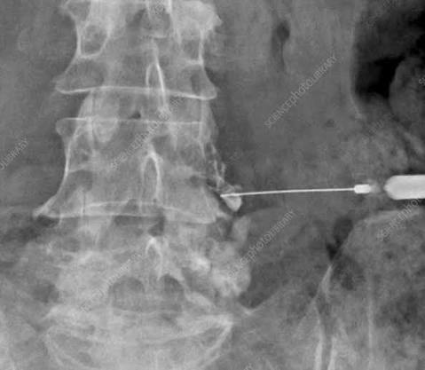 Nerve Root Blocks