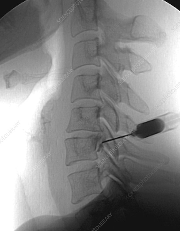 Epidural Steroid Injections