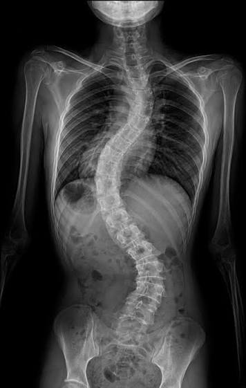 Facet Joint Injections