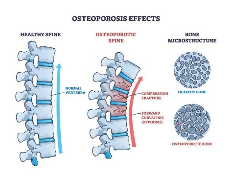 Osteoporosis treatment