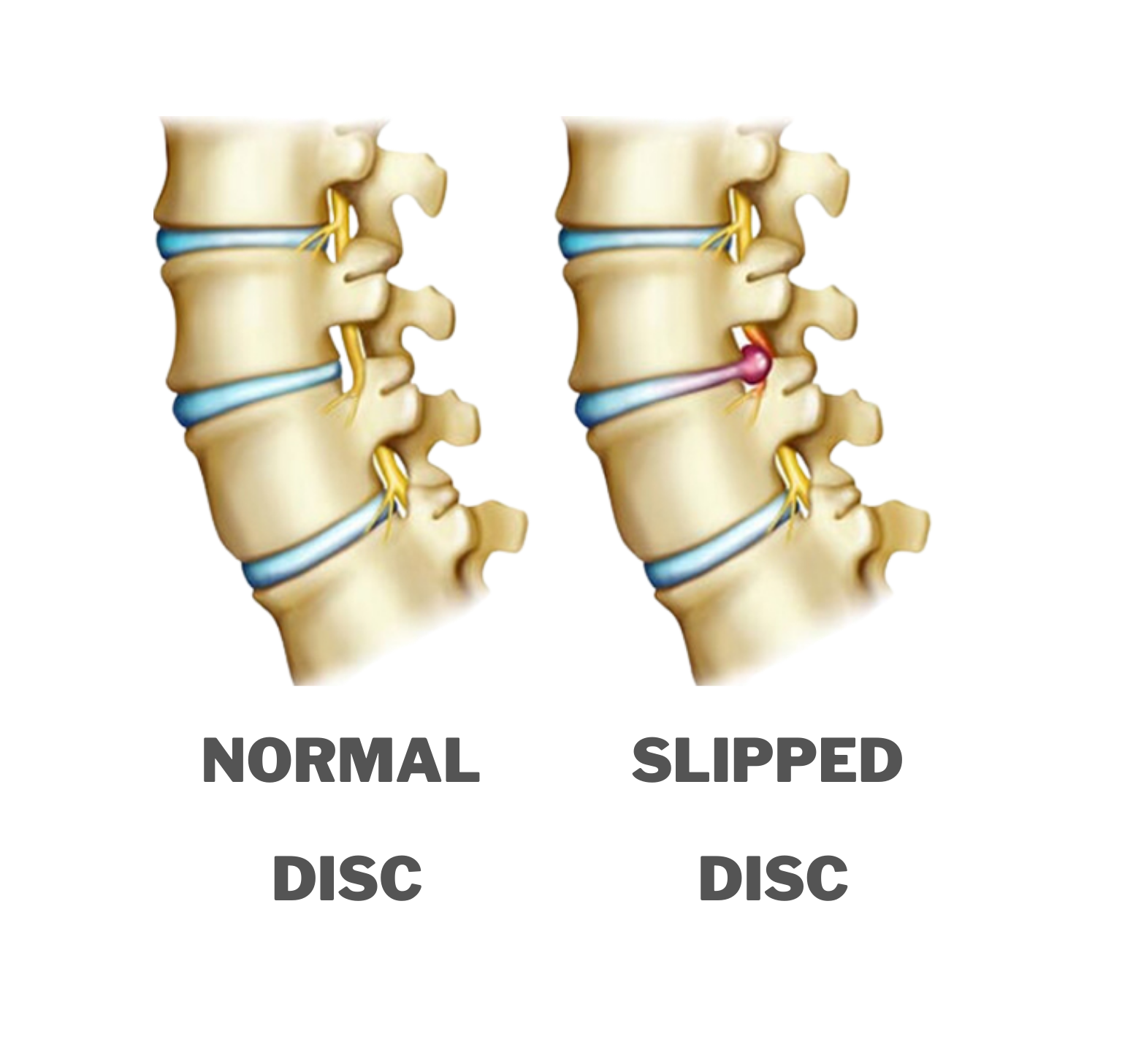 Slipped Disc Treatment