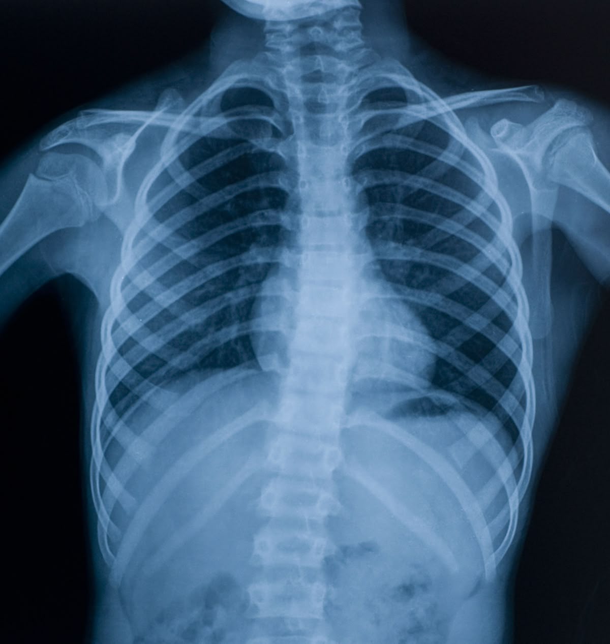 Spinal curvature