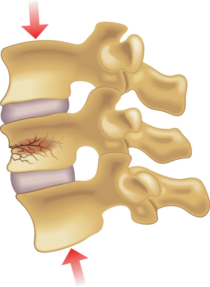 Pressure on the spinal cord