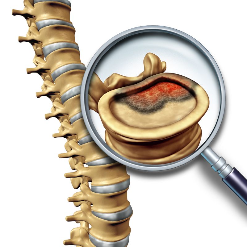 Spine tumor treatment