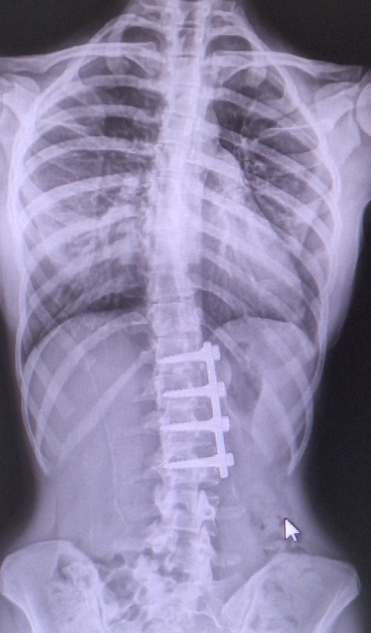 Spine surgery