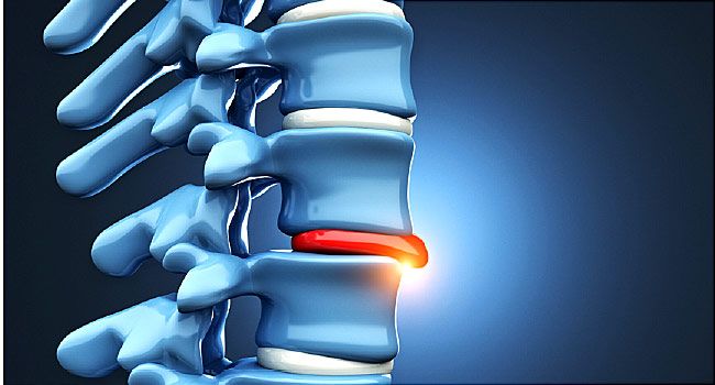 Sciatica symptoms