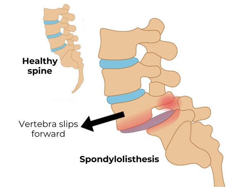 Spondylolysis and spondylolisthesis treatment