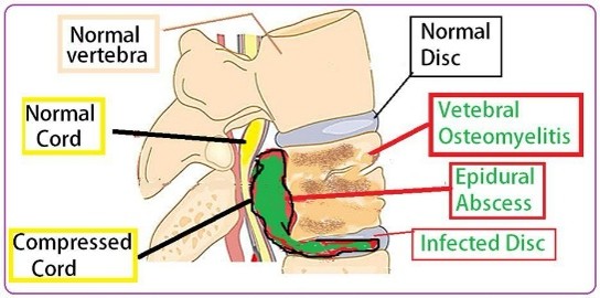 Sciatica leg pain treatment