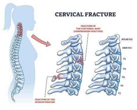 Cervical spine fracture treatment