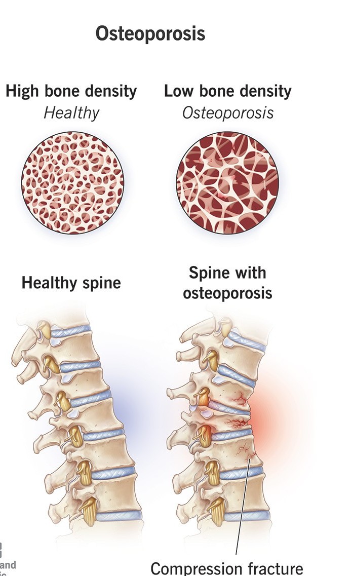 Thoracic myelopathy treatment